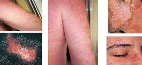 Prednisone for Lupus treatment